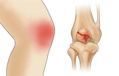 普通骨折术后康复