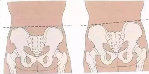 长短腿如何在日常生活中纠正